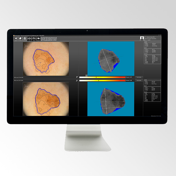 moleanalyzer dermatoscopio