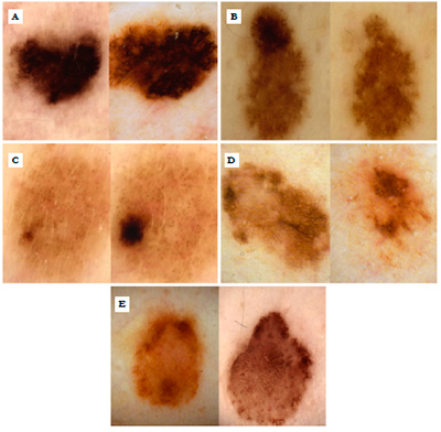 dermatoscopia digital